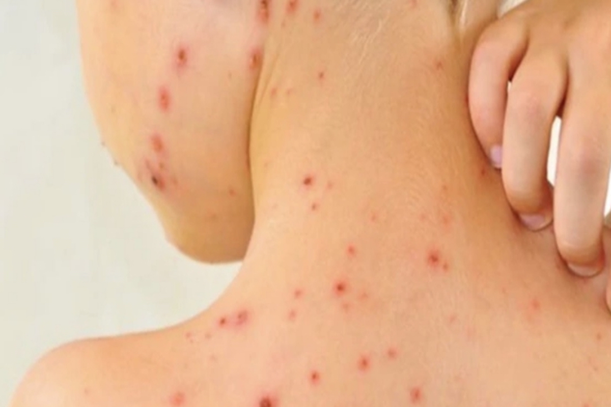 Se ejecuta protocolo de vigilancia epidemiológica y control ante caso de sarampión