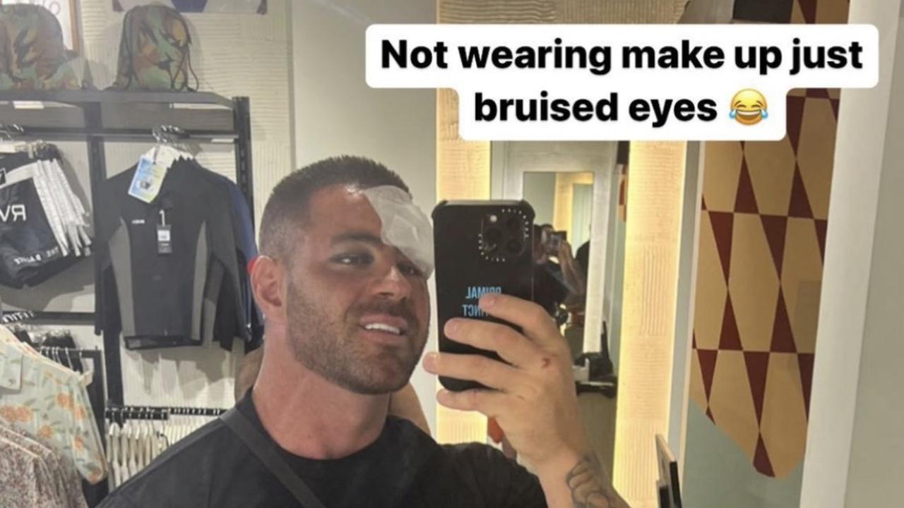 OnlyFans porn actor and reformed Gold Coast jailbird Dale Egan recounts  horrific Bali scooter crash | Gold Coast Bulletin