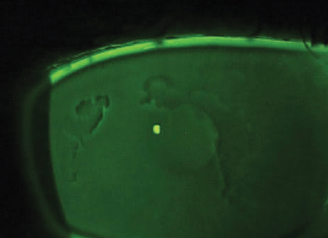 Chronic Erosion Syndrome Corneal Map Dot Fingerprint Dystrophy KUTN 0421 CF1 Fig1 