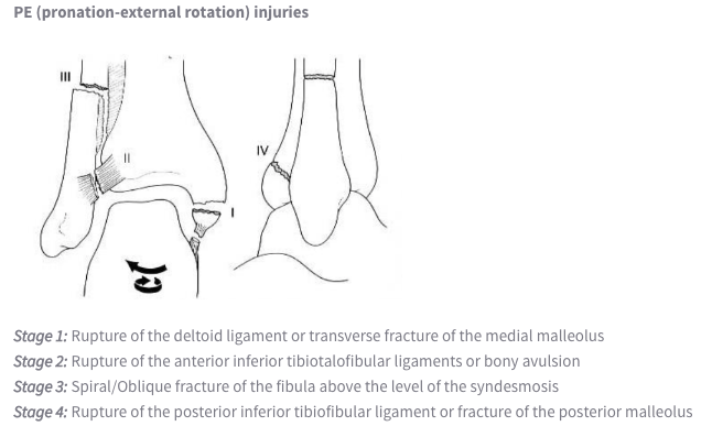 Pronation Internal Rotation Ankle Fractures – Core EM