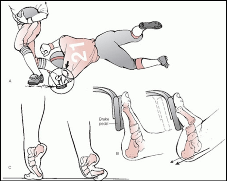 Lisfranc Injury Surgery . Lisfranc Injuries - Core EM