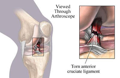 Acl Anterior Cruciate Ligament A torn ACL is considered a 2nd or 3rd degree ACL sprain.