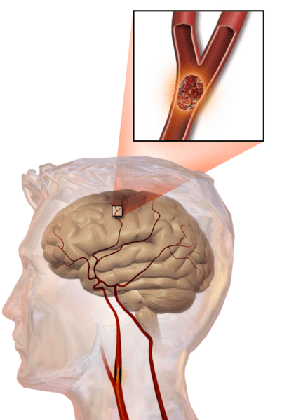 stroke