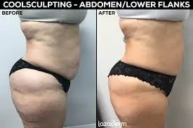 CoolSculpting