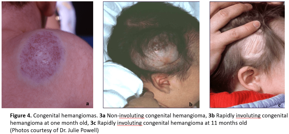 Dsd cavernous malformation treatment