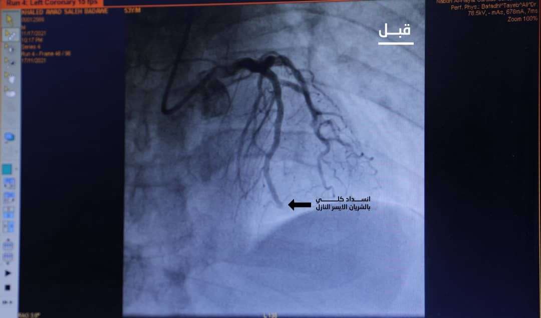 فريق مركز الملك سلمان للإغاثة الطبي التطوعي ينقذ حياة مريض مصاب بجلطة قلبية