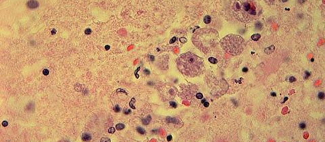 水道水から『人間の脳を食う』殺人アメーバ検出ーアメリカ