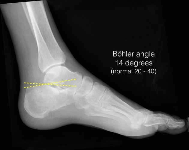 Paediatric Lower Limb Fractures