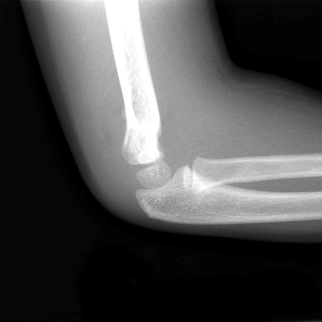 Paediatric Upper Limb Fractures