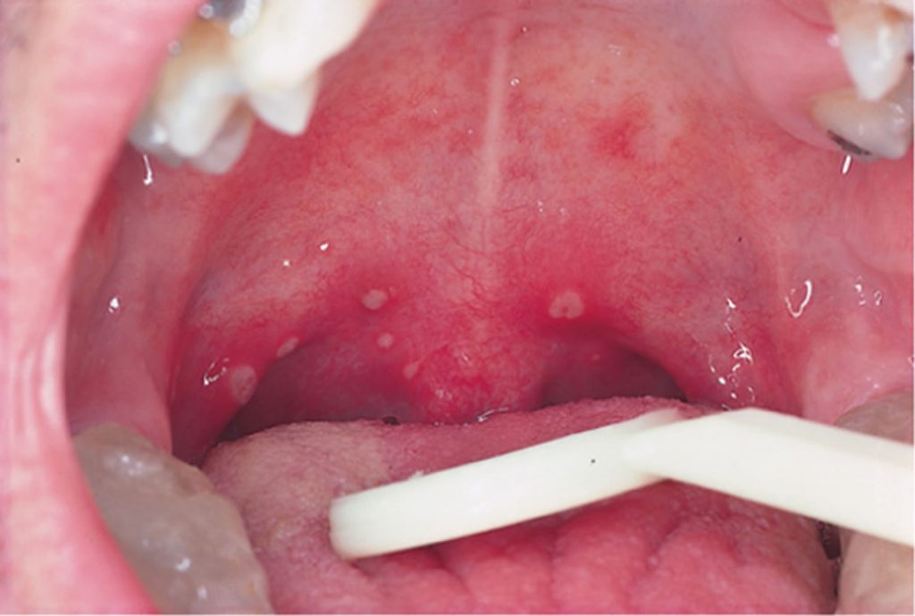 Paediatric sore throat