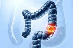 Colorectal cancer