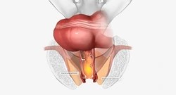 Fecal Incontinence