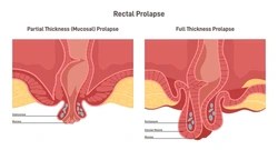 Rectal Prolapse
