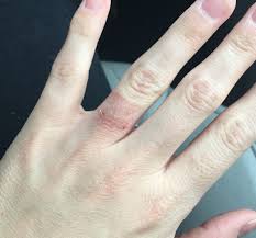Allergic reaction to wearing a ring