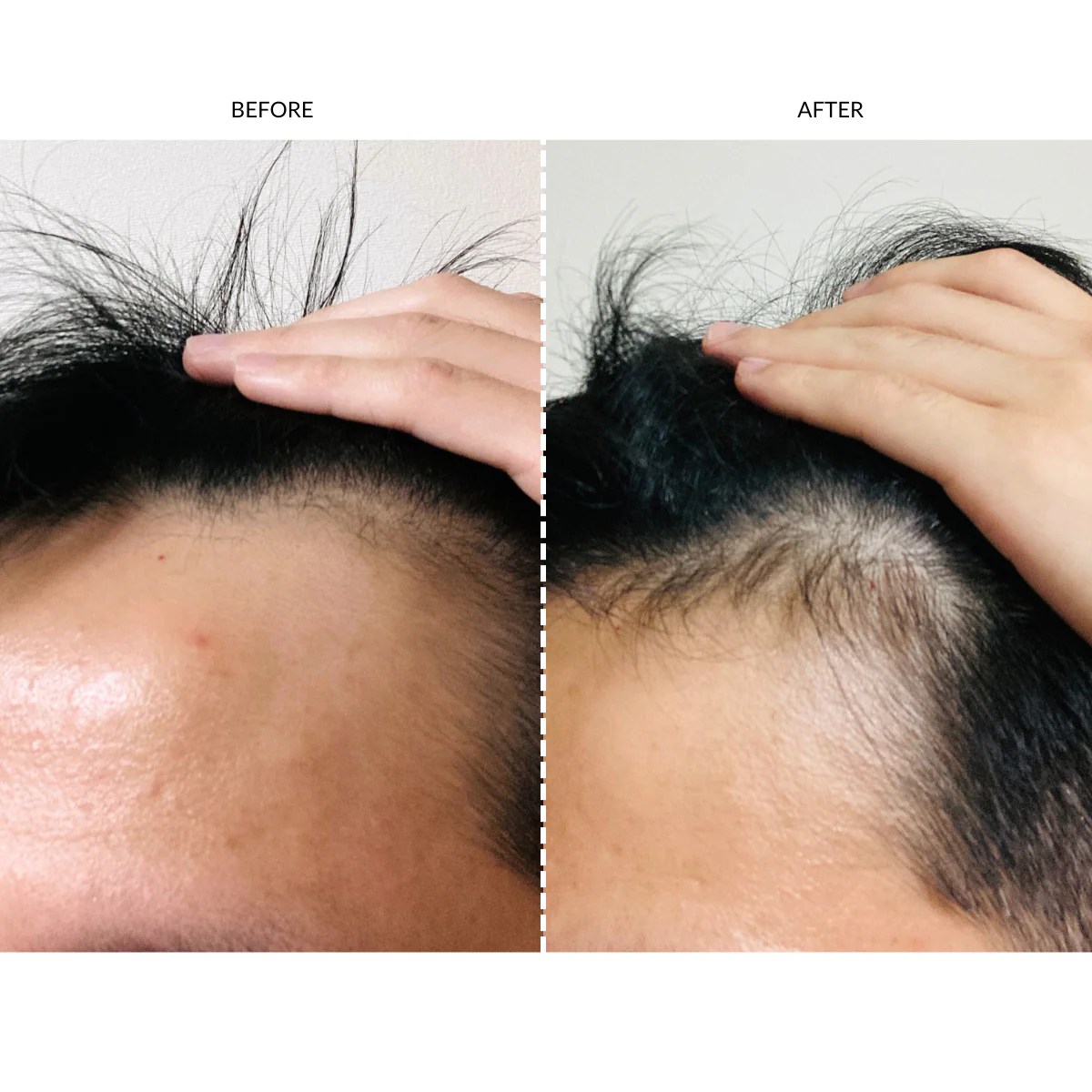 Does red light therapy help hair growth before and after