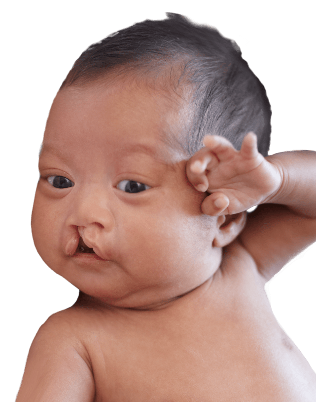 Meet some of the patients we have treated to become familiar with what you can expect if your child is affected with a similar problem. Cleft Lip And Palate