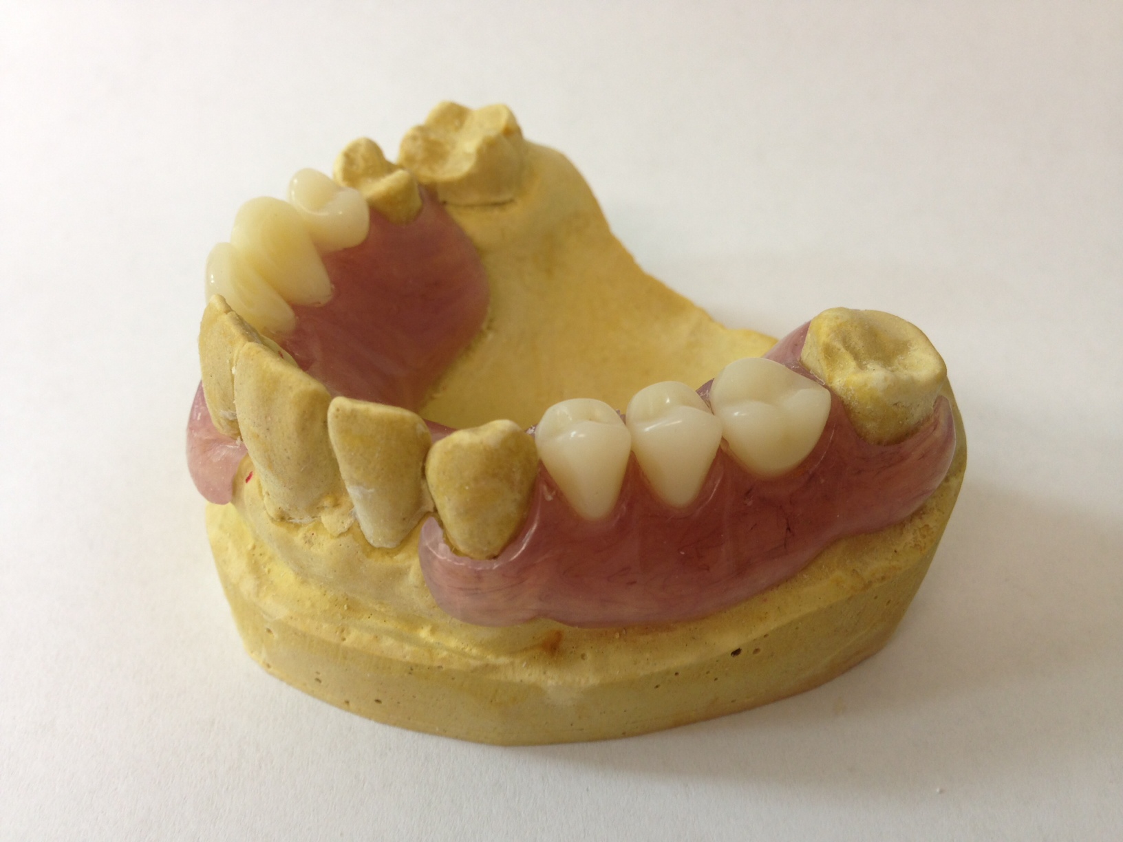 TCS Maxillary Appliance