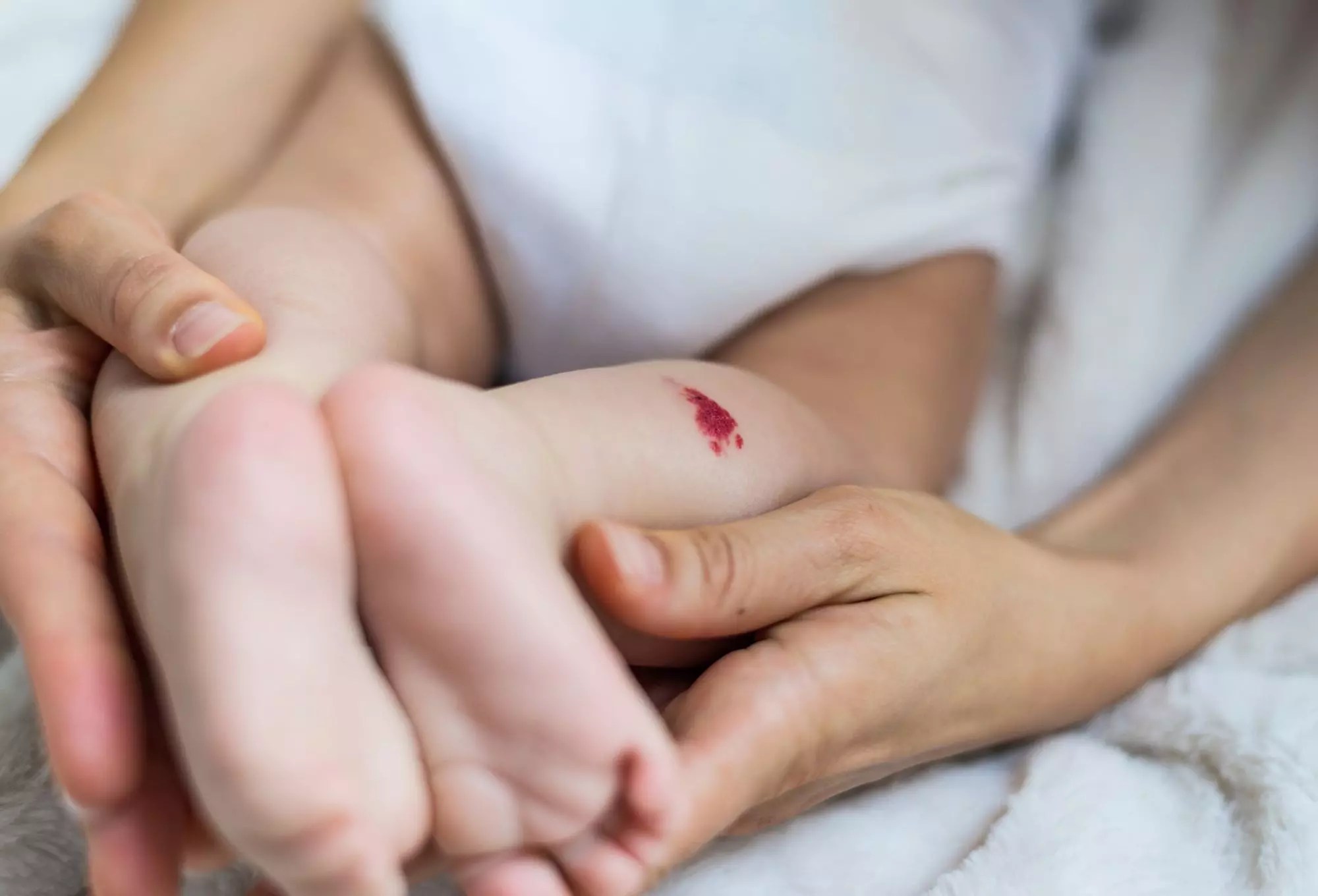 U mạch máu hay u máu (hemangiomas) là một dạng khối u phát triển từ sự tăng sinh bất thường của các thành mạch máu