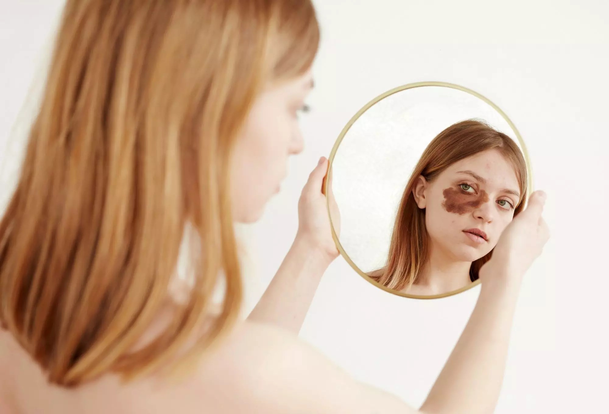 Bớt rượu vang biểu hiện bởi các mảng da sẫm màu