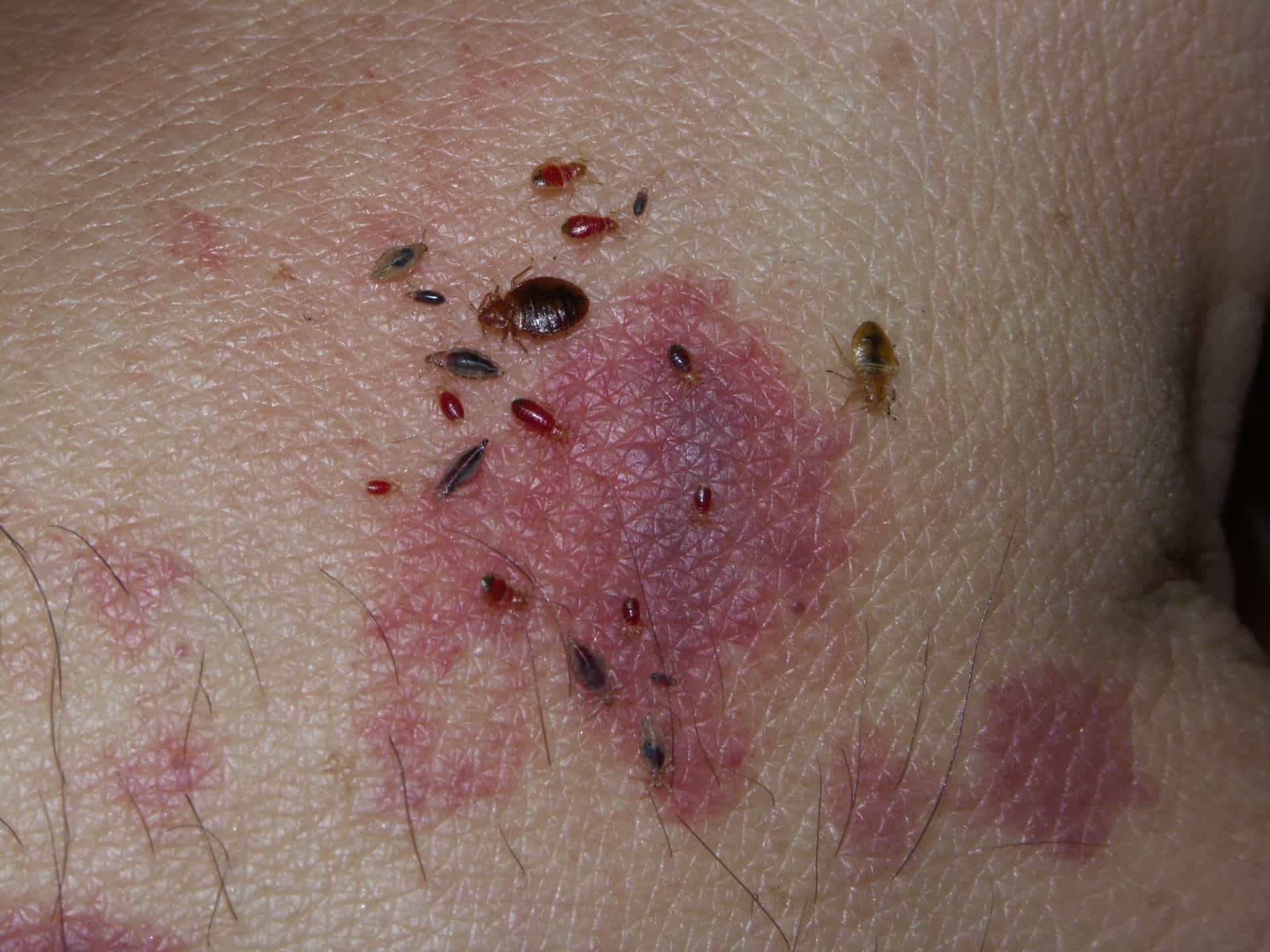 Bed Bug Bites on Arms 