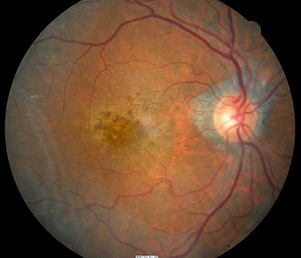 43+ Elegant Single Blind Procedure Definition - What Is Artificial Insemination with Husbandâs Sperm (AIH)? / Do you know how to shorten blinds?