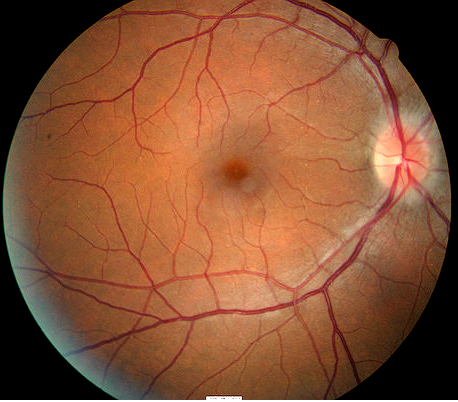 Thus, cerebral visual impairment is preferred to cortical blindness. H46.11-13 Retrobulbar Neuritis (Acute) - Decision-Maker PLUS