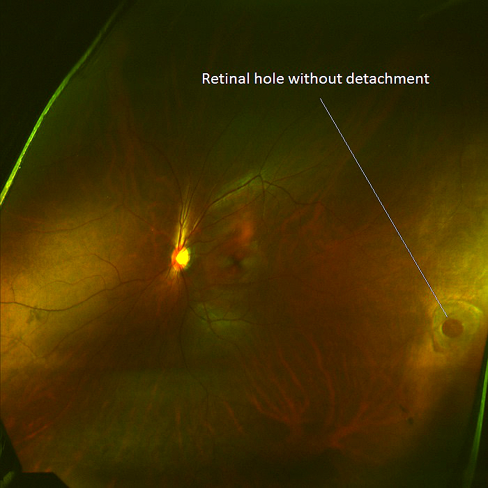 It's common for a sighted person to wonder what blind people see or for a blind person to wonder whether the experience is the same for other. H33.011-013 Retinal Detachment with Retinal Defect