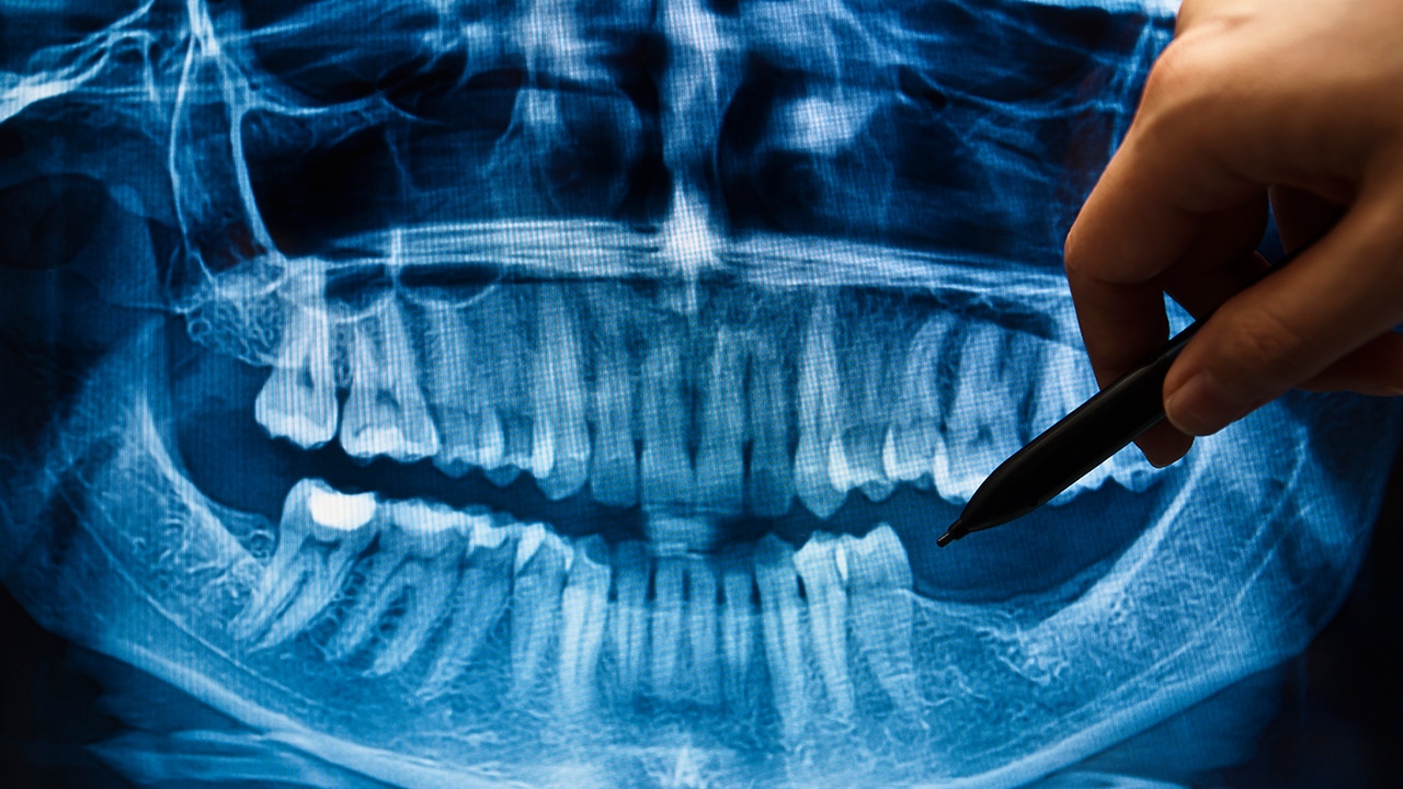 New Technique Aims to Simplify Dental Bone Graft Procedures Decisions