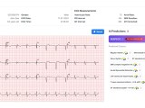 Deepecg Ai Powered Ecg Analysis