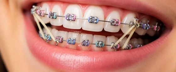 Elastics and buttons used with invisible dental braces