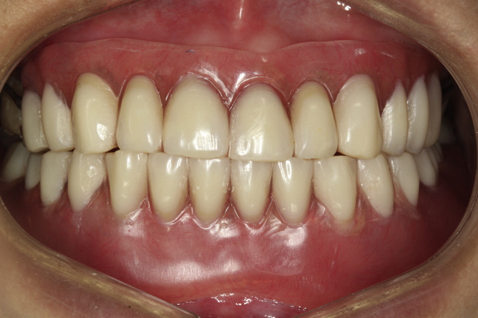 methamphetamine effects on teeth