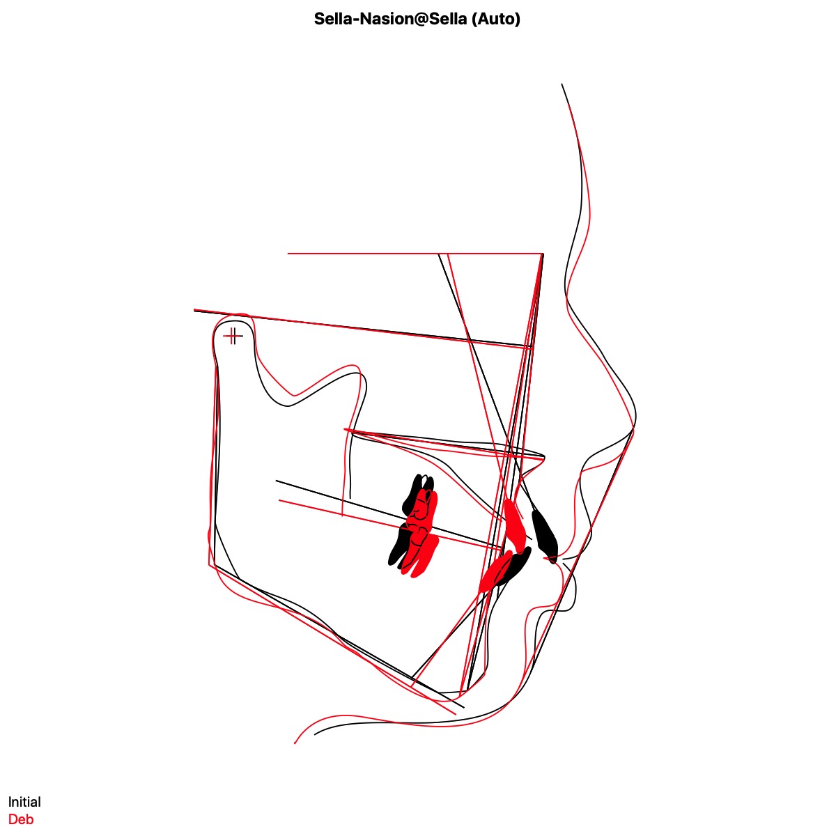 きりりと凛々しい口元に/抜歯を視野に入れたワイヤーによる矯正治療