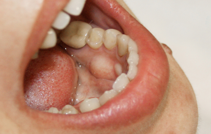 While it is believed to be genetic, the cause of tori growth is not completely . Denturaid Torus Mandibularis Denturaid