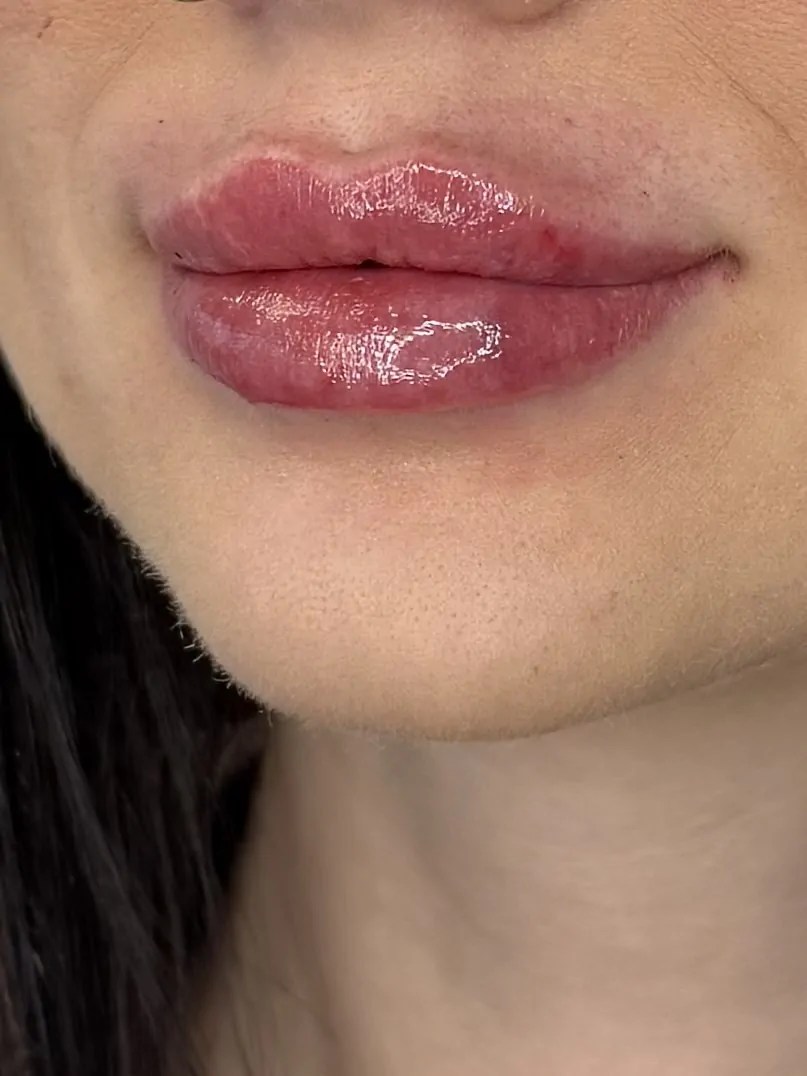 Dermalax Plus photo review