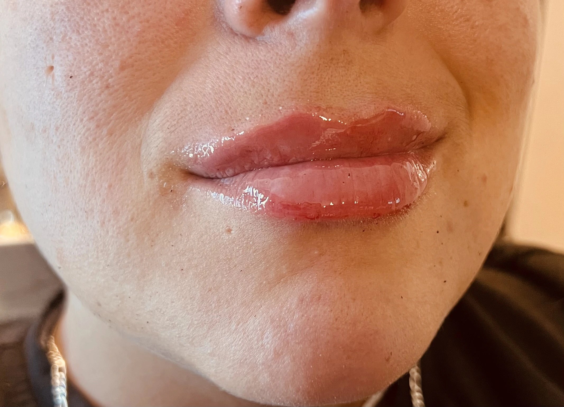 Neuramis Deep with Lidocaine photo review