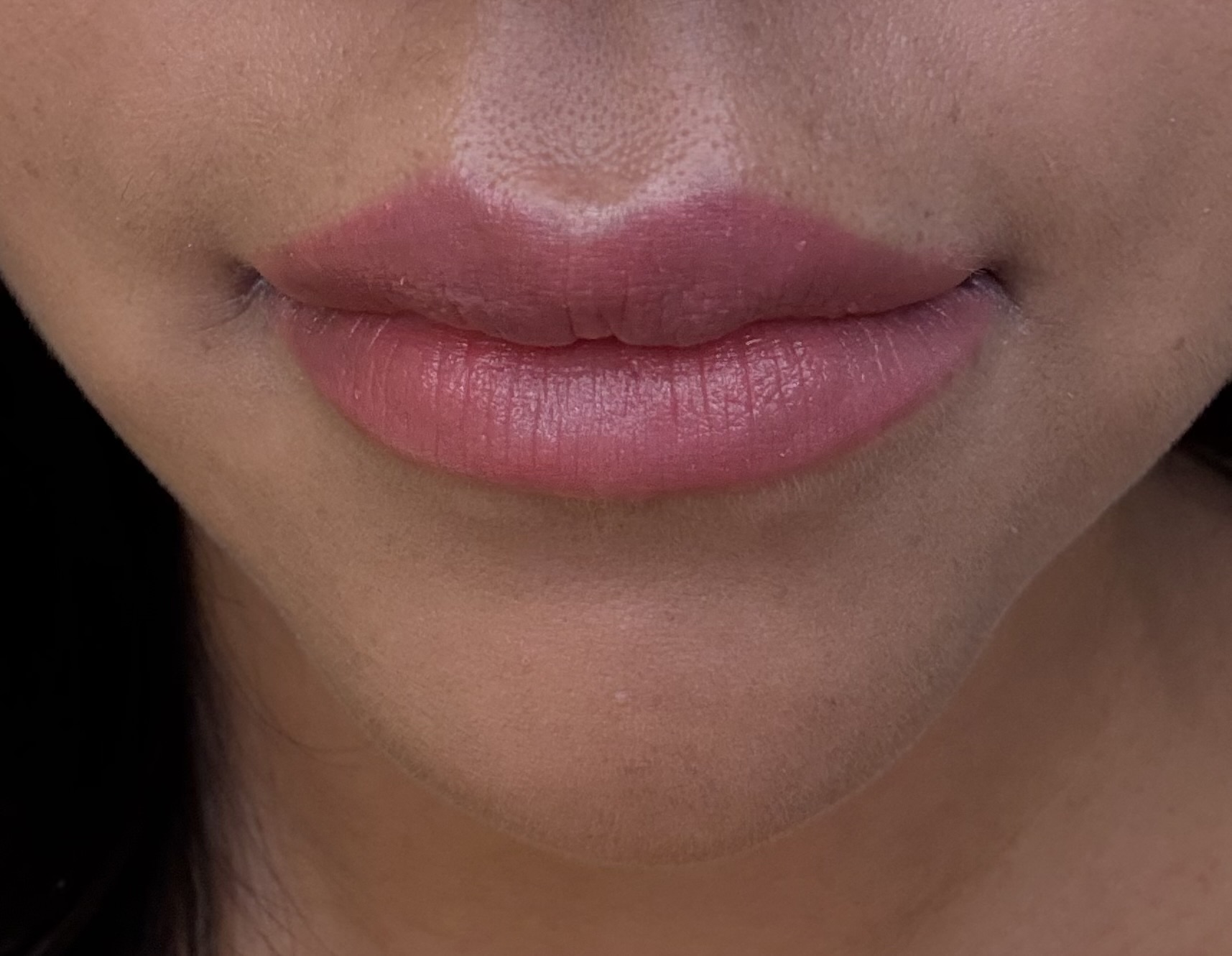 Neuramis Lidocaine photo review