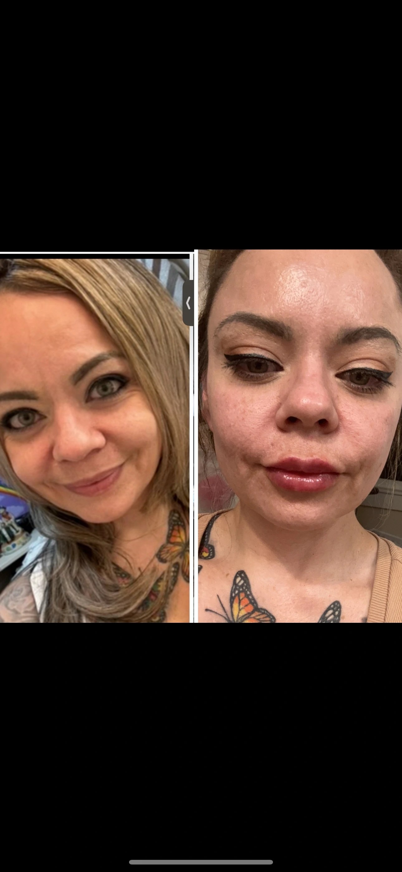 Neuramis Deep with Lidocaine photo review