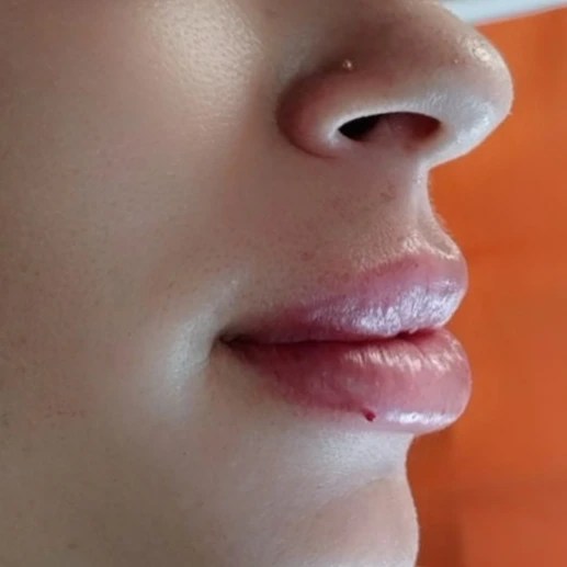 Neuramis Deep with Lidocaine photo review