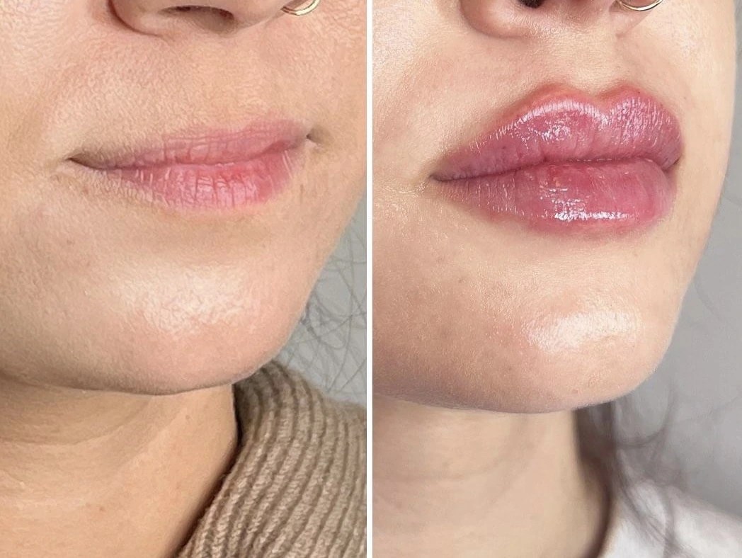 Neuramis Deep with Lidocaine photo review