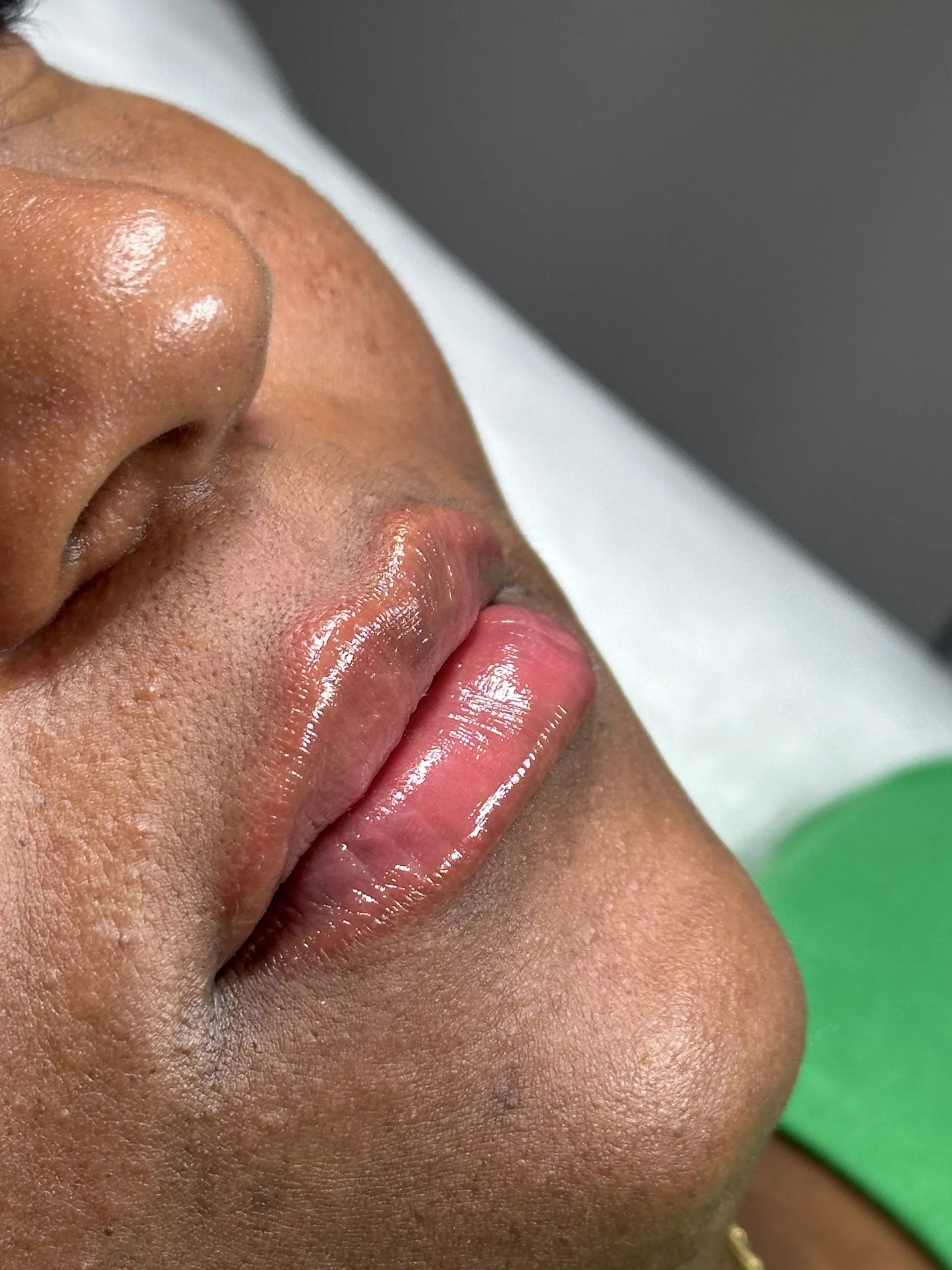 Neuramis Deep with Lidocaine photo review