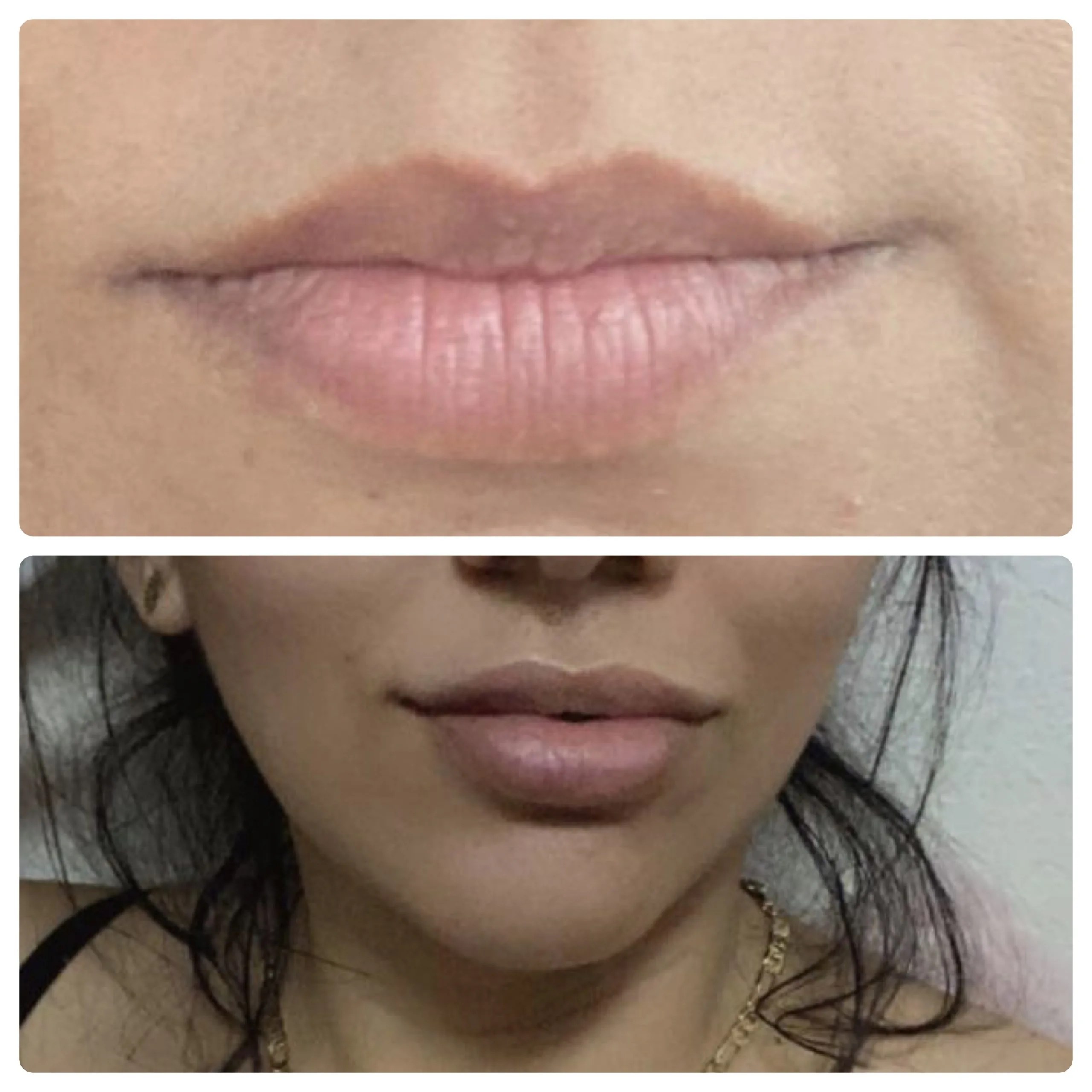 Neuramis Deep with Lidocaine photo review