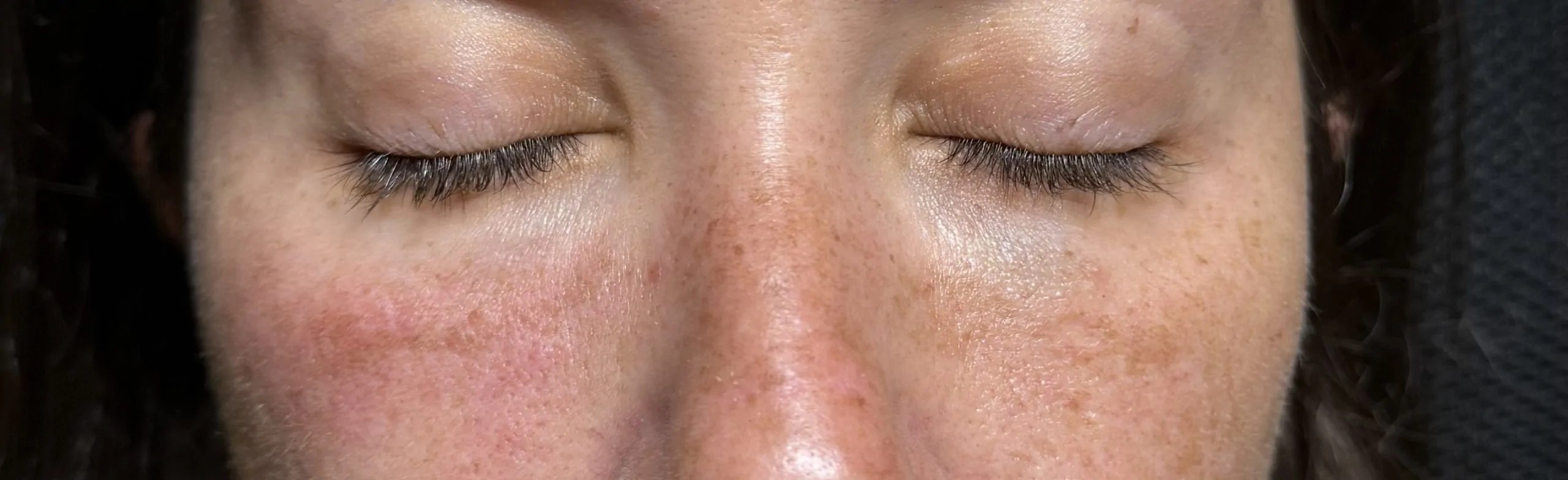 Liporase photo review