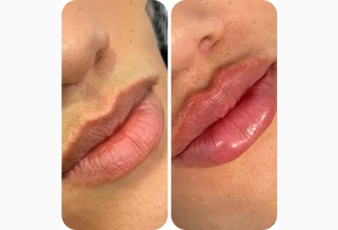 Neuramis Deep with Lidocaine photo review