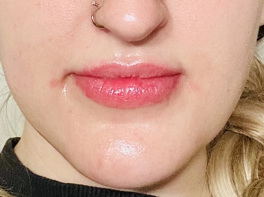 Neuramis Deep with Lidocaine photo review