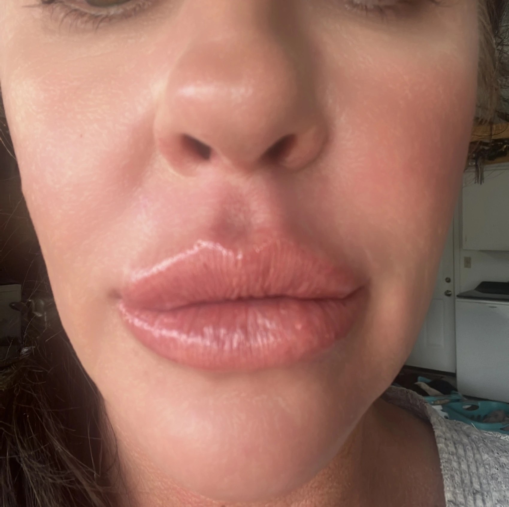 Neuramis Deep with Lidocaine photo review