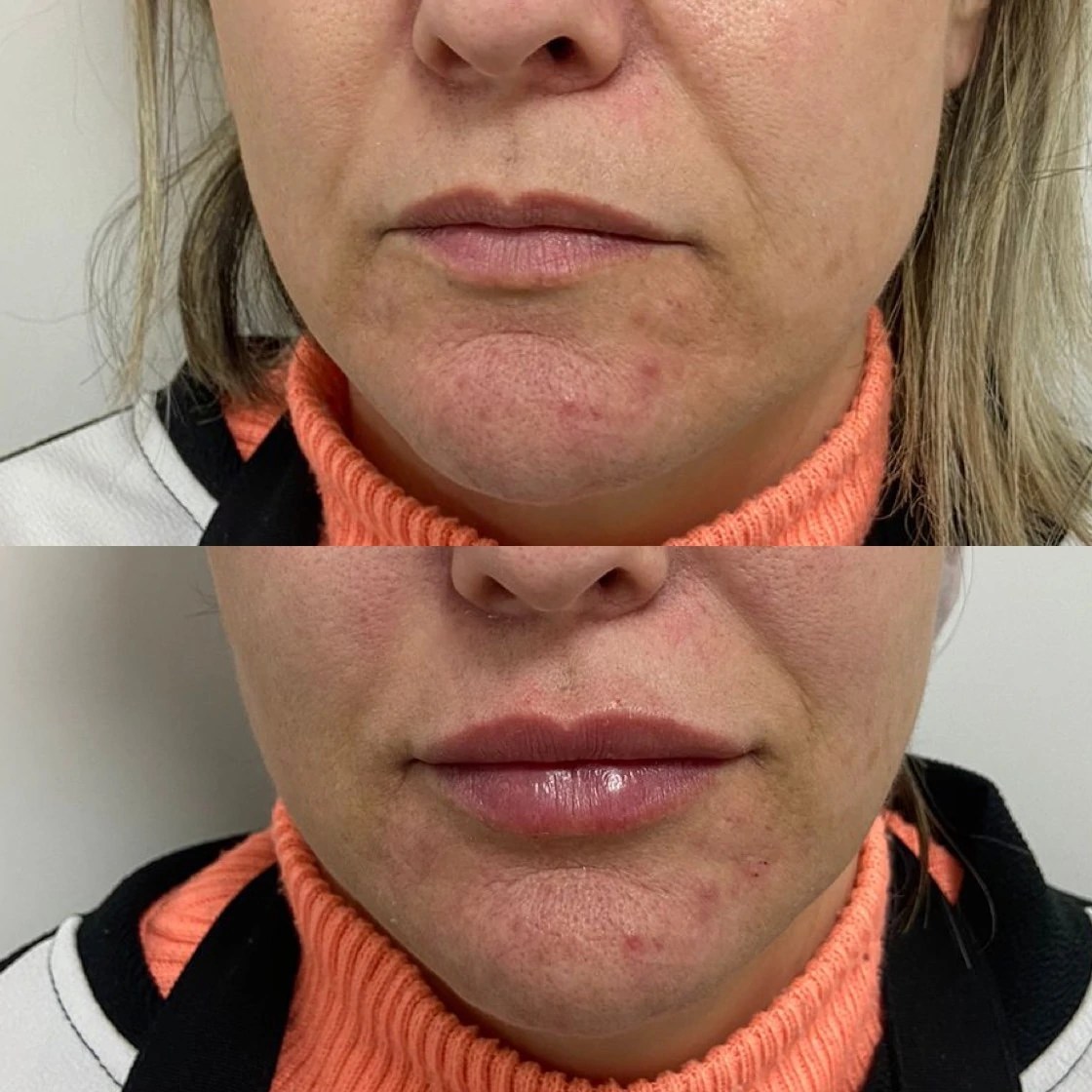 Neuramis Deep with Lidocaine photo review