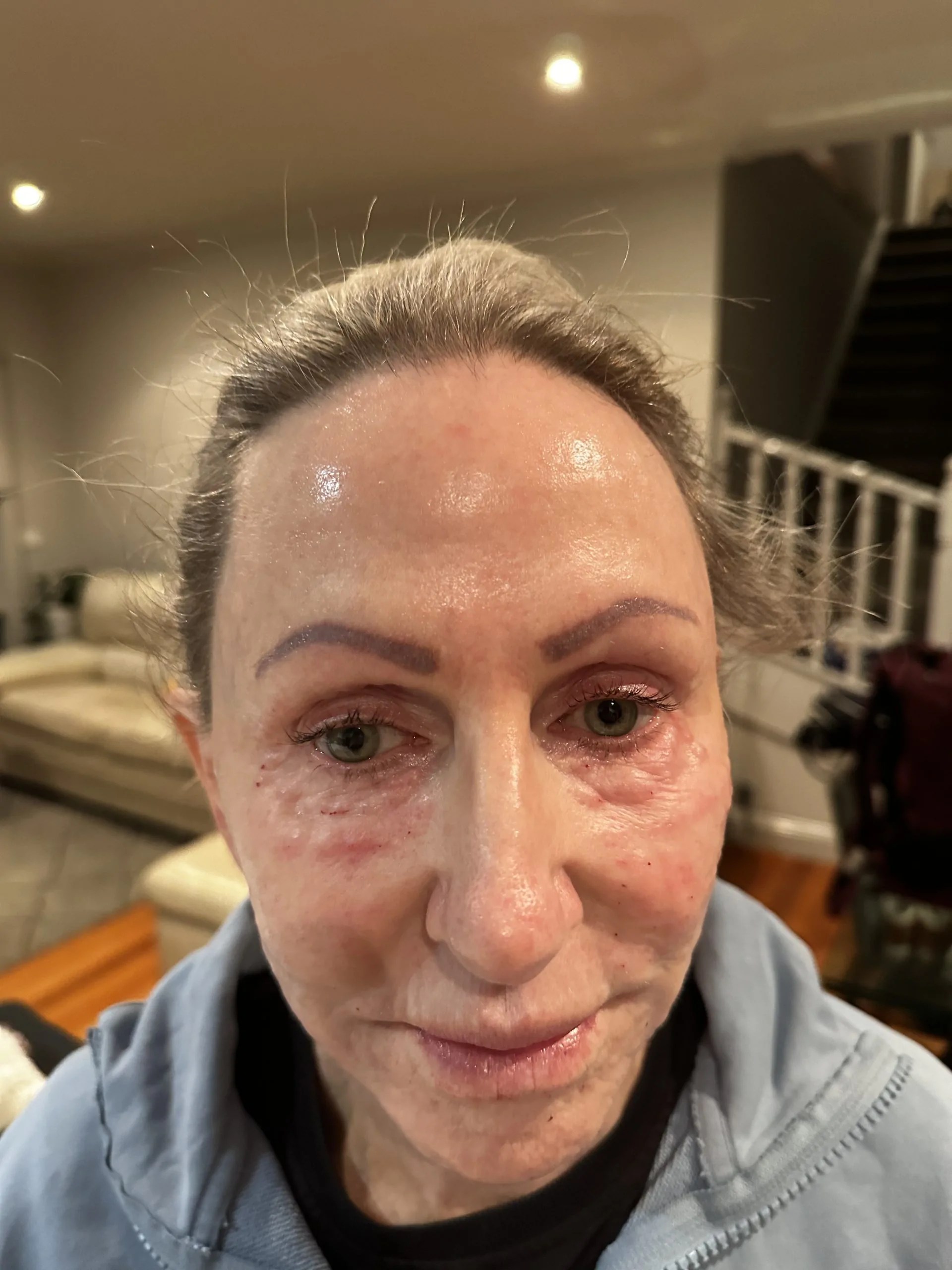 Rejuran i photo review