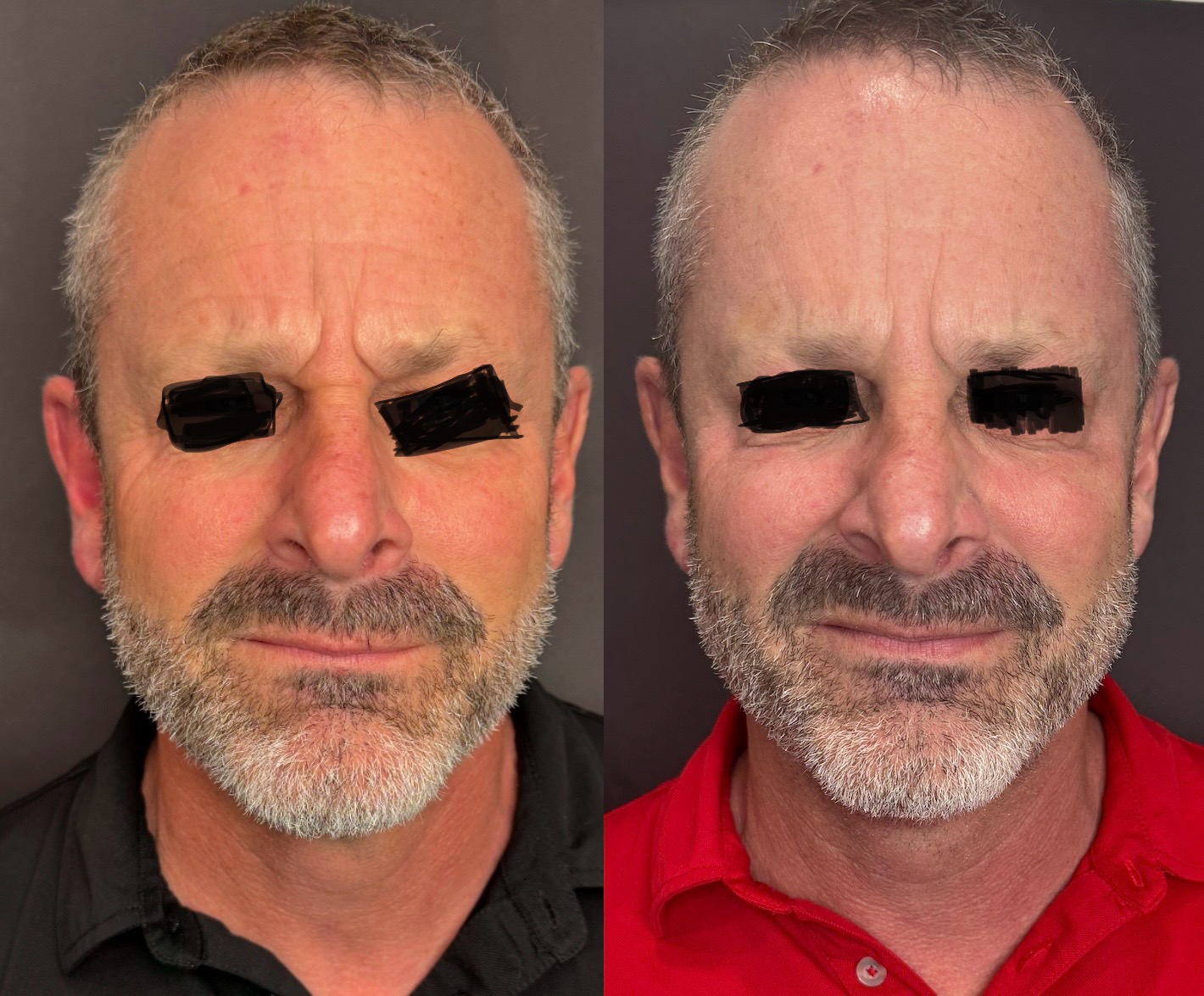 Botulax 200 Units photo review