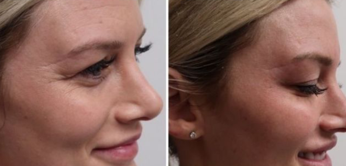 Innotox 100 Units photo review