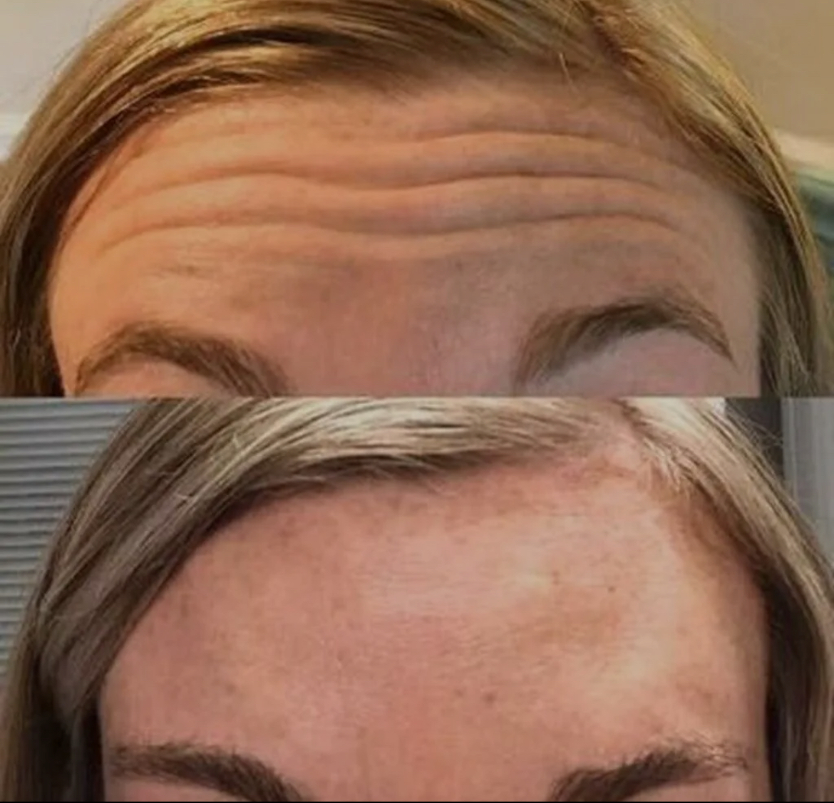 Innotox 100 Units photo review